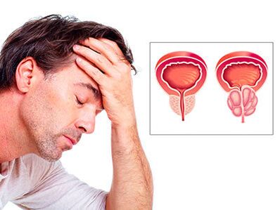 Les symptômes de la prostatite inquiètent un homme
