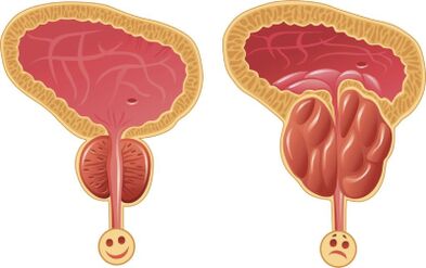 Prostate masculine saine et enflammée