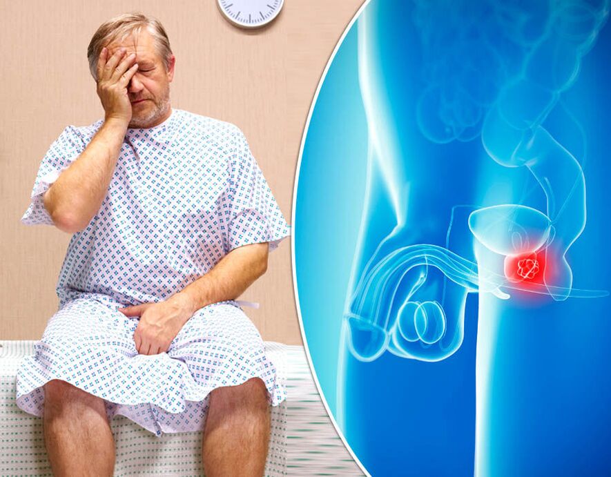 Un homme atteint de prostatite reçoit un diagnostic de maladie